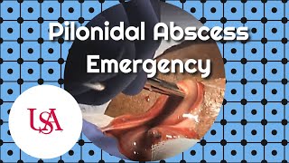 Pilonidal Abscess Emergency Incision amp Drainage [upl. by Mail]