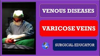 Varicose Vein Symptoms and Signs [upl. by Wightman]