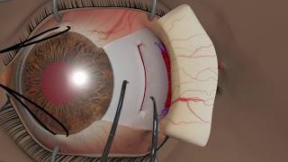 Strabismus surgery Recession [upl. by Dressler628]