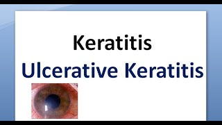 Ophthalmology 110 a Keratitis Cornea Inflammation Corneal Ulcer Ulcerative Ulceration [upl. by Frazer]