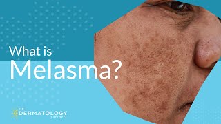 What is Melasma  Melasma Treatment Explained [upl. by Nollid]