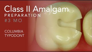 Class II Amalgam Preparation 3 MO [upl. by Cowie]