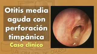 Otitis media aguda con perforación timpánica [upl. by Aynav632]