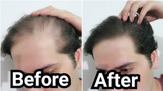 How I Grew Back my Hair with Rosemary Oil My Results w Pictures Before amp After  How To Use [upl. by Fugazy]