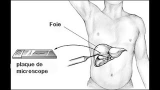 VOUS SAVEZ LA BIOPSIE HEPATIQUE [upl. by Esteban]