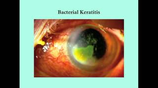 Keratitis  CRASH Medical Review Series [upl. by Aharon]