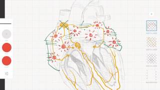 Cardiología y ECG Taquicardias supraventriculares vs ventriculares [upl. by Aymahs]