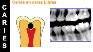 Aspectos Radiograficos de la Caries Dental [upl. by Akkina439]