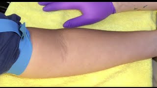 Tips For Locating Difficult Veins [upl. by Eenhat]