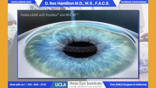 LASIK  Refractive Surgery  understand the procedure [upl. by Gorski279]