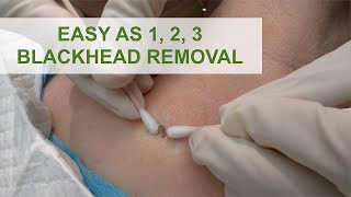 Easy as 1 2 3 Blackhead Removal  Dr Derm [upl. by Rohpotsirhc]