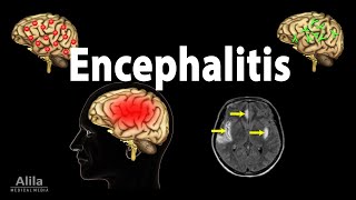 Encephalitis Animation [upl. by Sterrett]