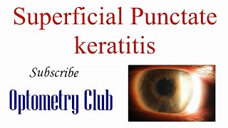 Superficial Punctate Keratitis Introduction Diagnosis and Treatment [upl. by Laeynad]