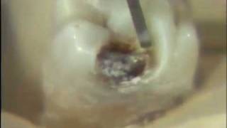 Removal of Carious Lesion [upl. by Shorter]