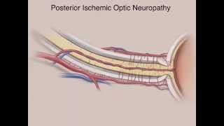 Ischemic Optic Neuropathies [upl. by Germain]